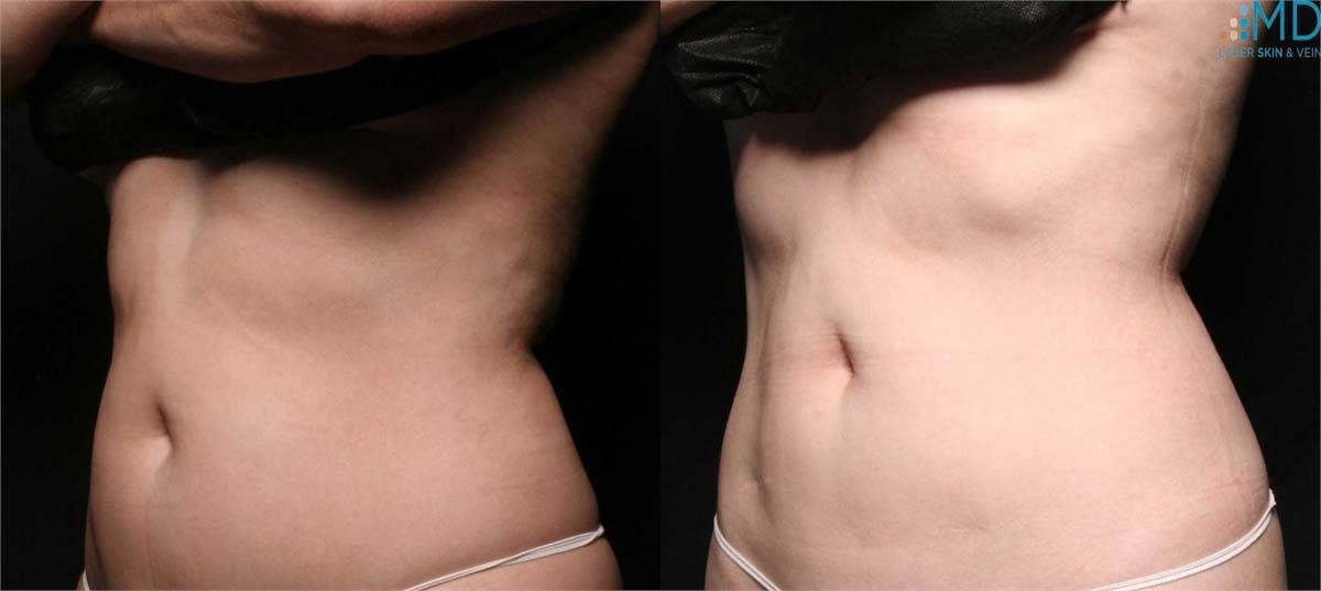 CoolSculpting Before and After Image