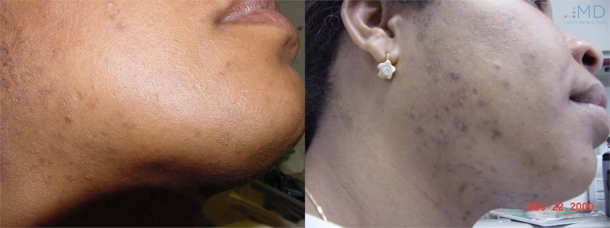 Laser Hair Removal Before and After 2