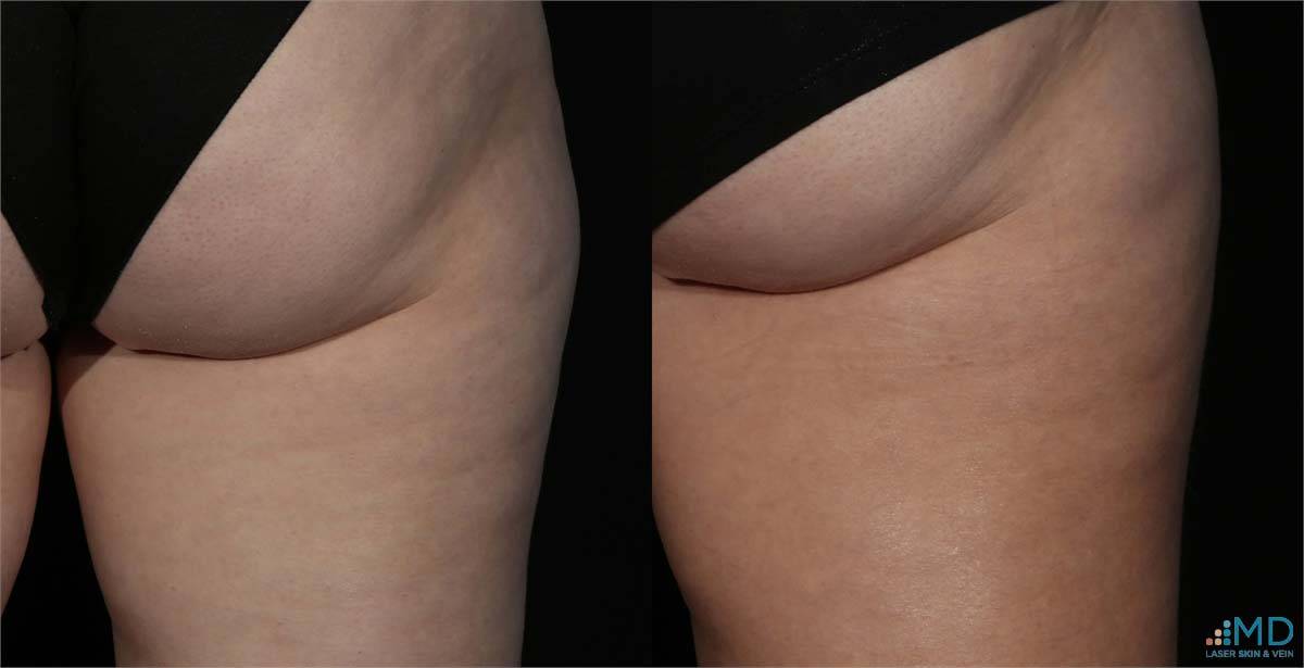 SculpSure Before and After 3