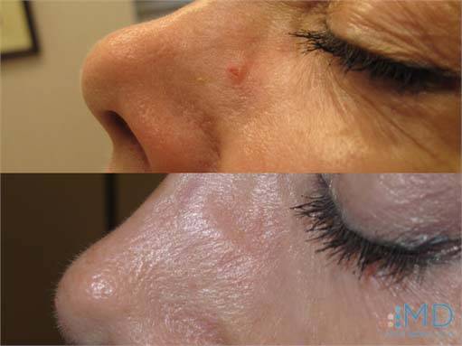 Before and After of Basal Cell Carcinoma Treatment