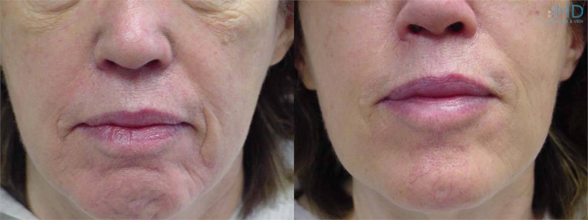 Before and After Nose to Mouth Lines Treatment 2