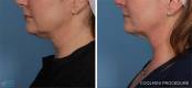 CoolSculpting Before and After Image 16