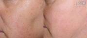 Photorejuvenation before and after 4
