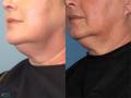 CoolSculpting Before and After Image 14