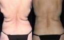 CoolSculpting Before and After Image 10