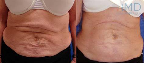 Before and After Sagging Skin Treatment 1