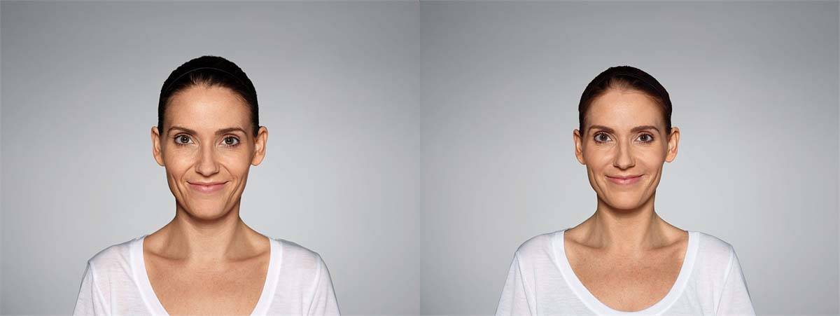 Restylane Defyne Before and After Image 1