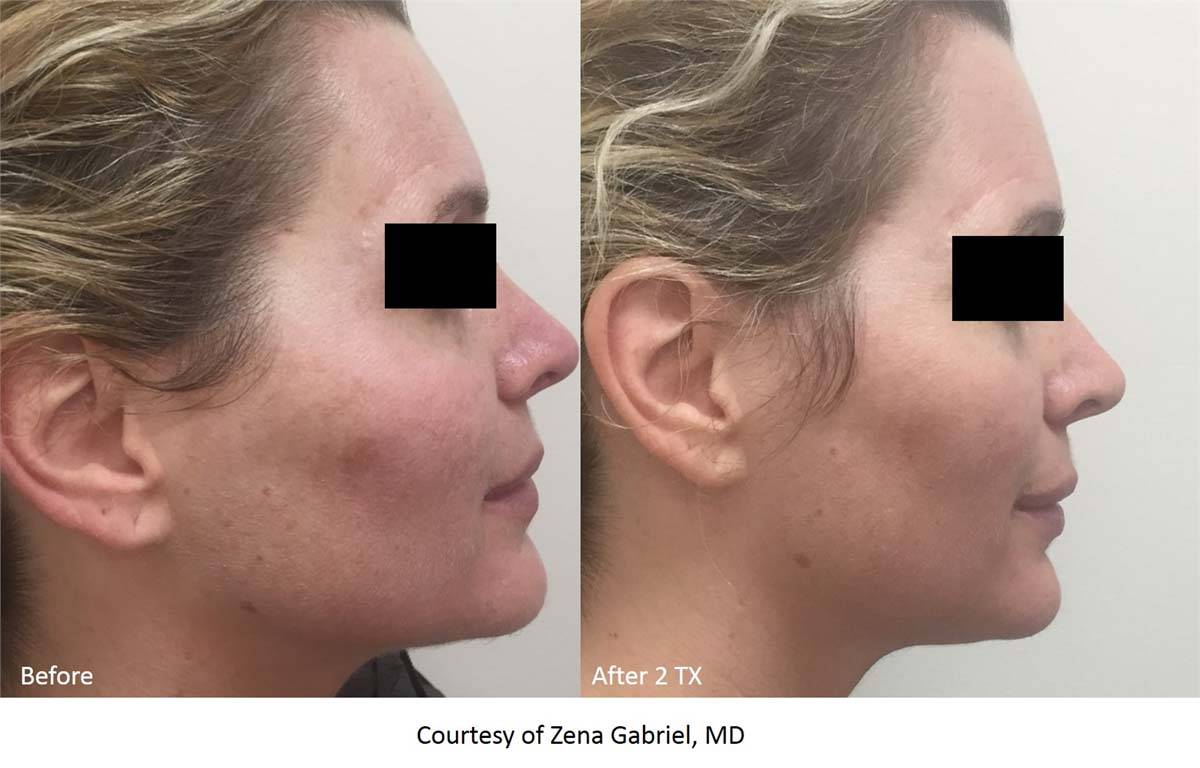 LaseMD Before and After profile
