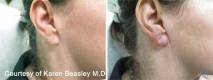 Earlobe rejuvenation Before and After 2