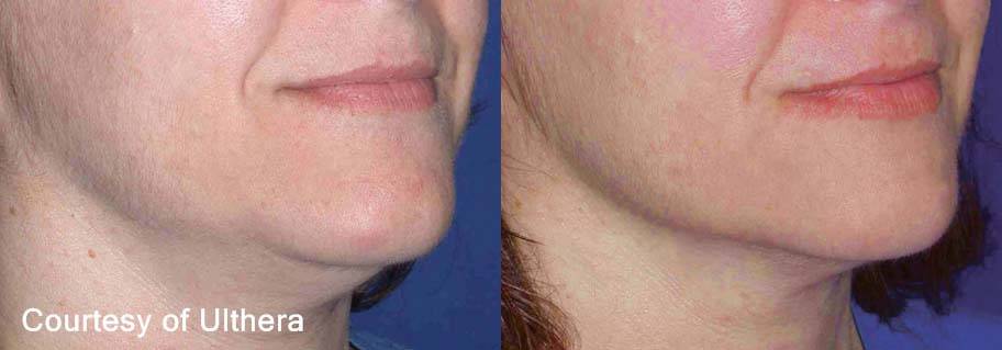 Before and After Sagging Skin Treatment 5
