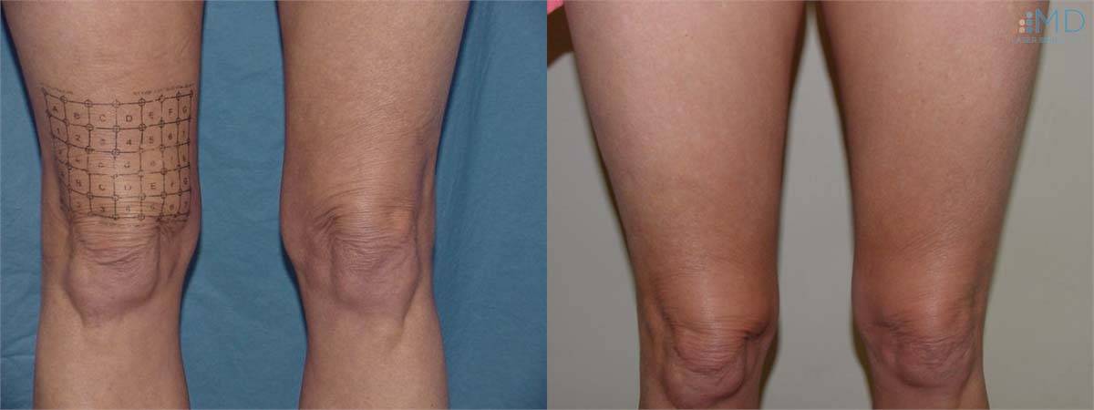 Before and After Sagging Skin Treatment 3