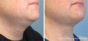 Kybella Before and After 5