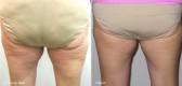Before and After Cellulite Treatment 4