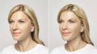 Restylane Silk Before and After Image 3
