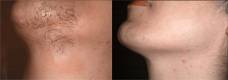 Laser Hair Removal Before and After 4