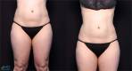 CoolSculpting Before and After Image 7