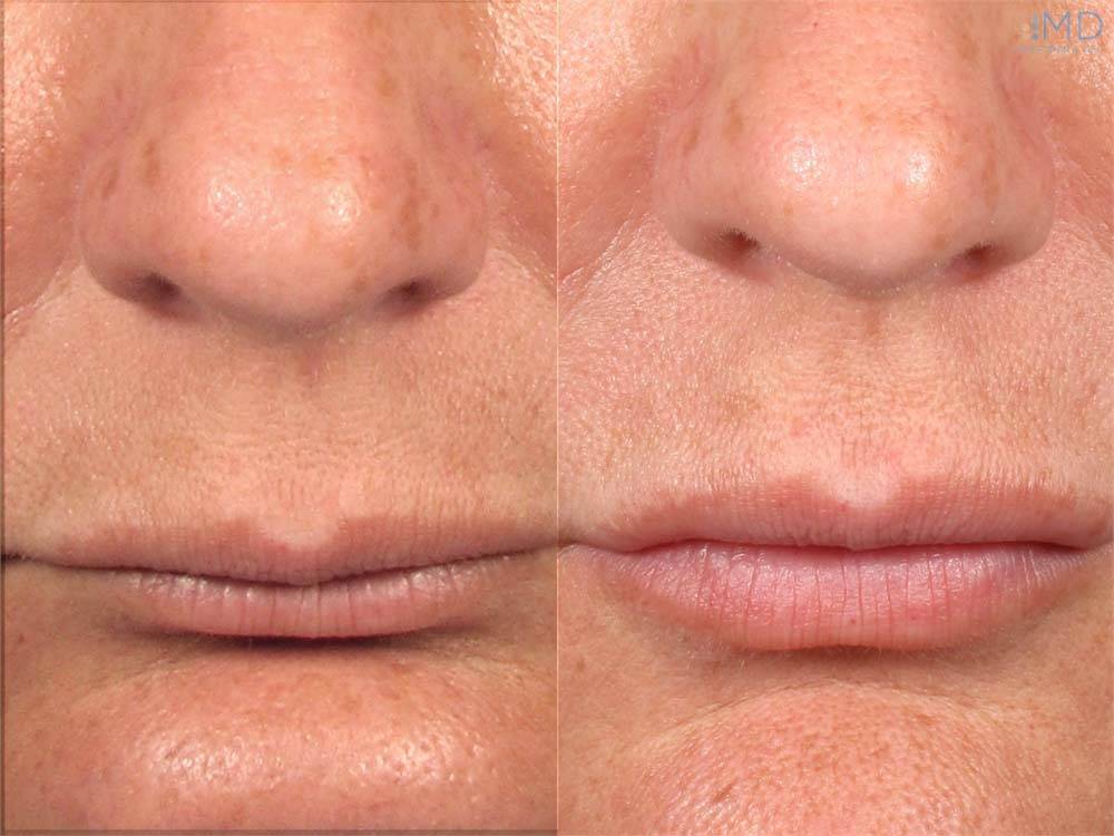 Restylane Silk Lips Before and After Image 3