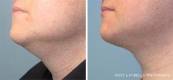Kybella Before and After 8