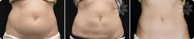 Before and After Unwanted Fat Treatment 4
