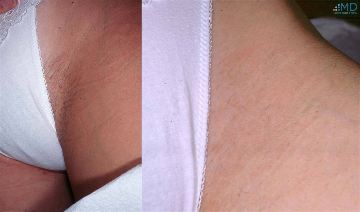 Laser Hair Removal Before and After 5