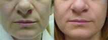 juvederm before and after image 4