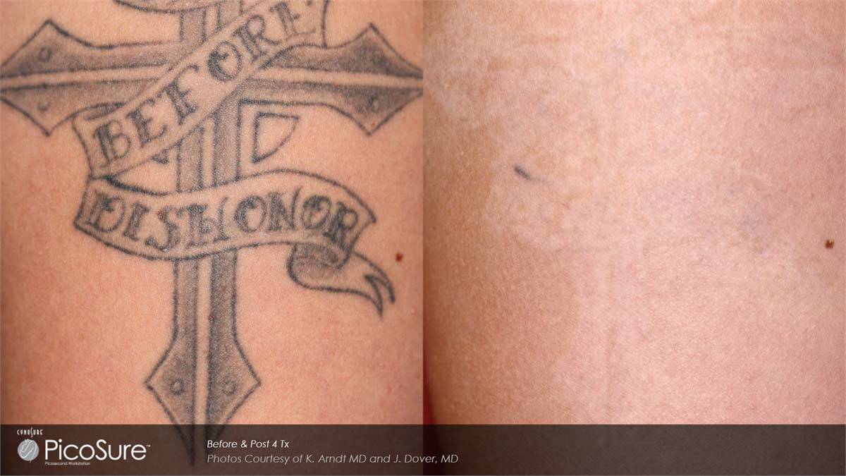 PicoSure Tattoo Removal Before and After 3