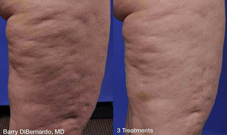 Before and After Cellulite Treatment 3