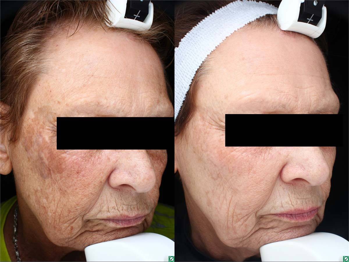PicoSure Before and After 2