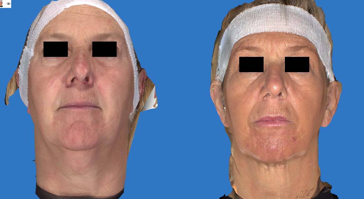 Kybella Before and After 4