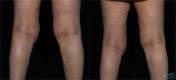 CoolSculpting Before and After Image 4
