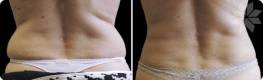 Before and After Unwanted Fat Treatment 3