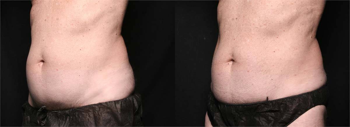Before and After Unwanted Fat Treatment 5