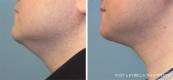 Kybella Before and After 7