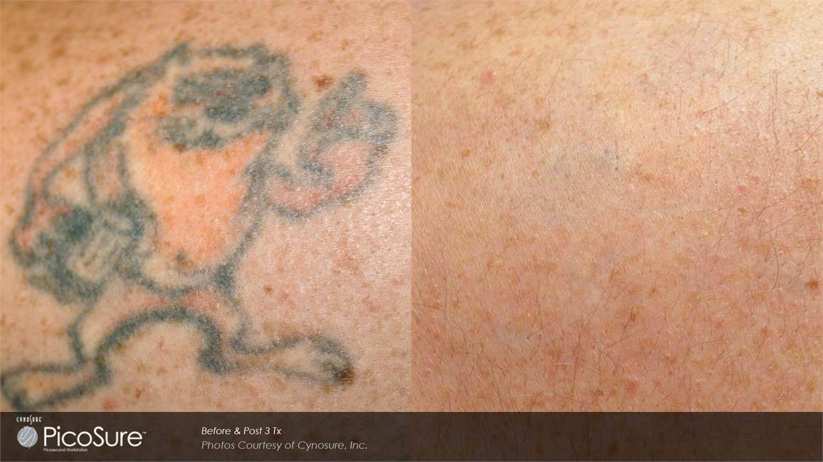 PicoSure Tattoo Removal Before and After 2
