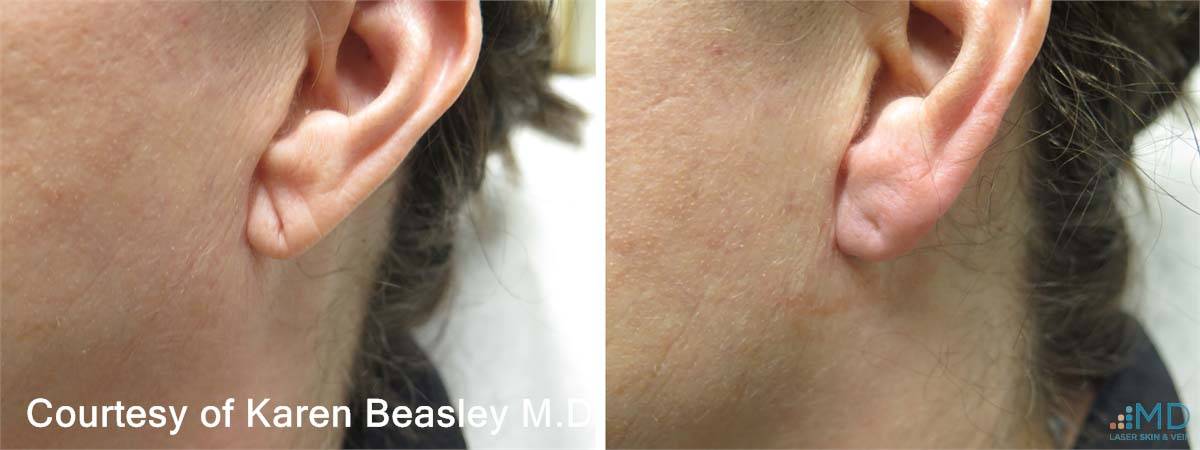 Earlobe rejuvenation Before and After 2