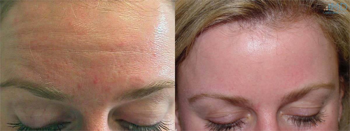 Botox Before and After Image