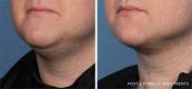 Kybella Before and After 9