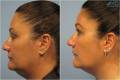 Before and After Sagging Skin Treatment 4