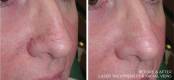 Before and After Enlarged Blood Vessels Treatment 1